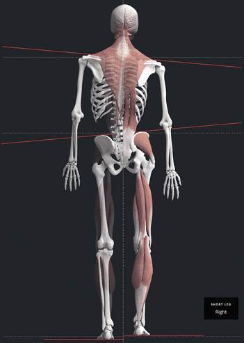 Full-body render showing postural imbalance and a functional short leg from craniocervical misalignment