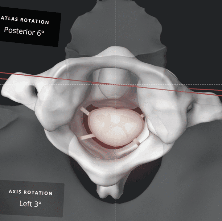 Top-down 3D render of an atlas vertebra showing rotation measurements