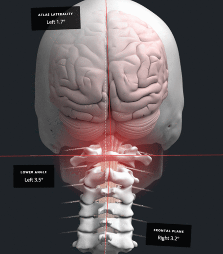 NUCCA analysis showing a craniocervical (head and neck) misalignment