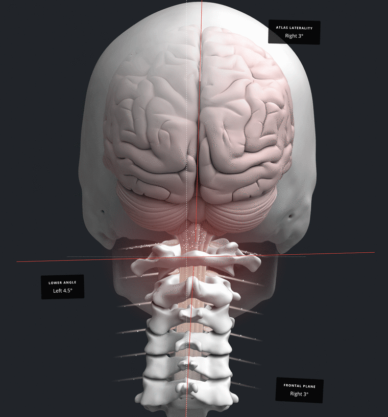 NUCCA analysis showing a craniocervical (head and neck) misalignment that can affect balance